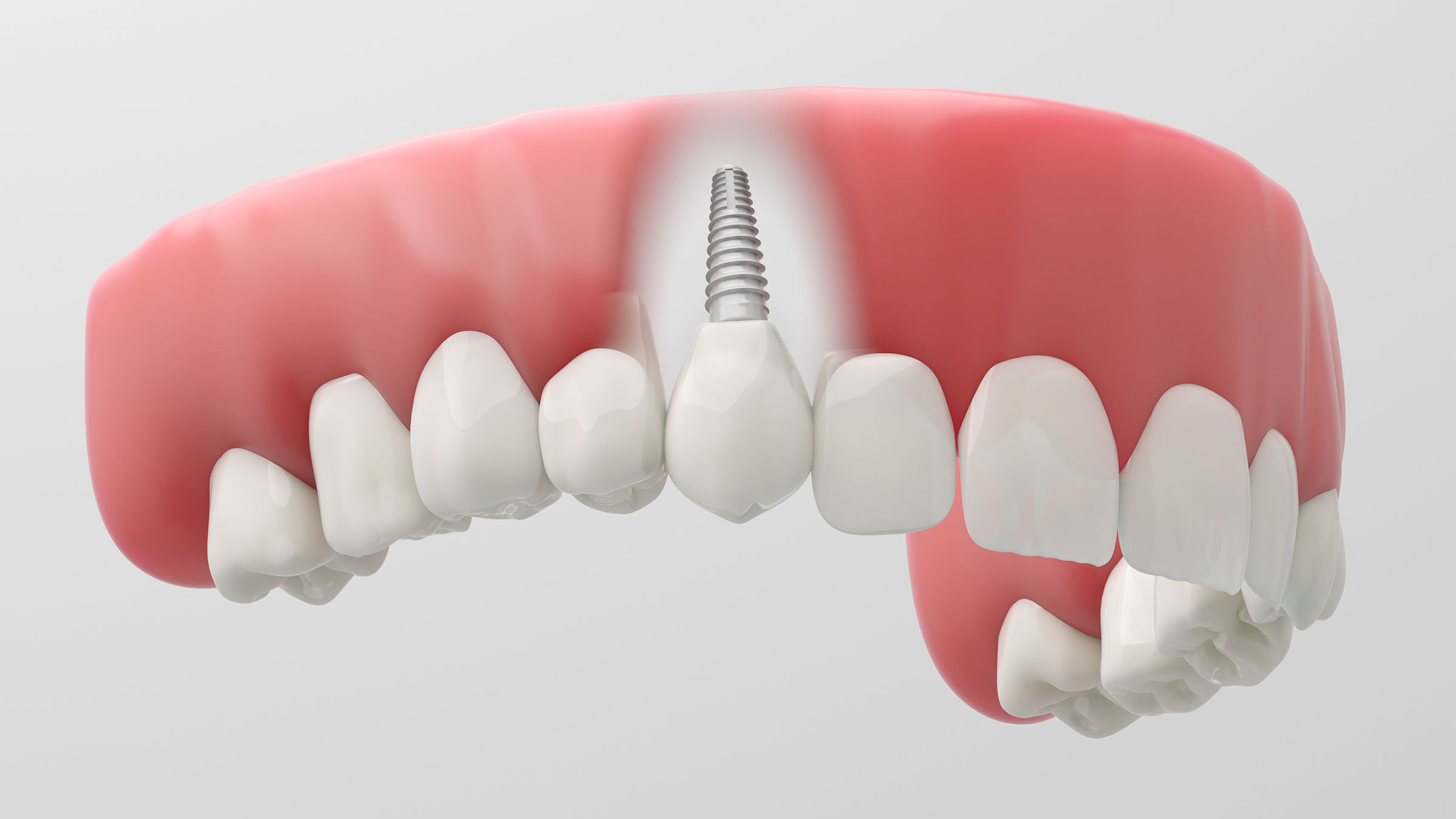 インプラントのイメージ3D画像