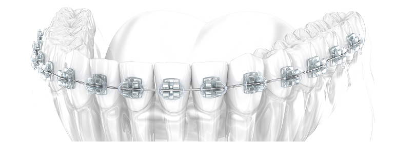 表側歯列矯正の3Dイメージ画像