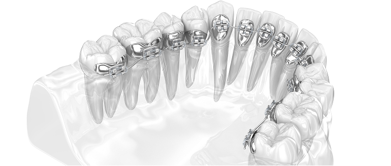 裏側歯列矯正の3Dイメージ画像