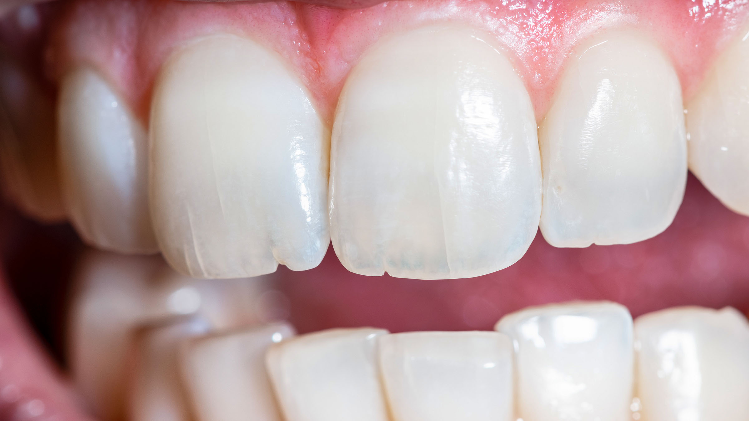 歯の亀裂や破折イメージ写真